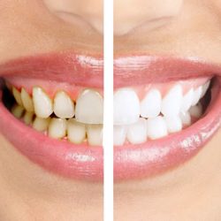 Почему важна профессиональная чистка зубов?